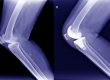 Prótesis articulares. Radiografía de prótesis de rodilla