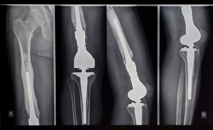 Prótesis de rodilla, cadera y tobillo, radiografía de prótesis de rodilla