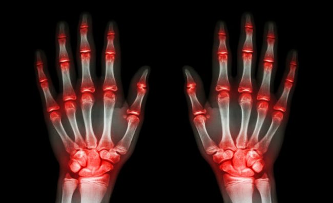 patología reumatológica patología reumatológica