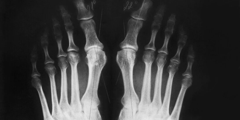 osteoarthritis patológia