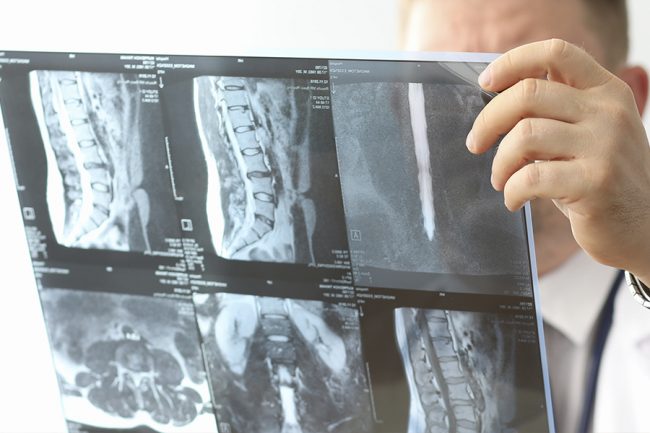 hernia-de-columna hernia discal