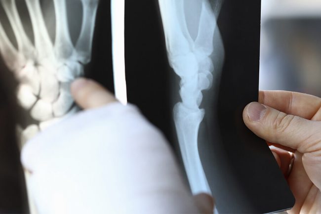 tratamiento-de-la-artrosis-1 Tratamiento de la artrosis