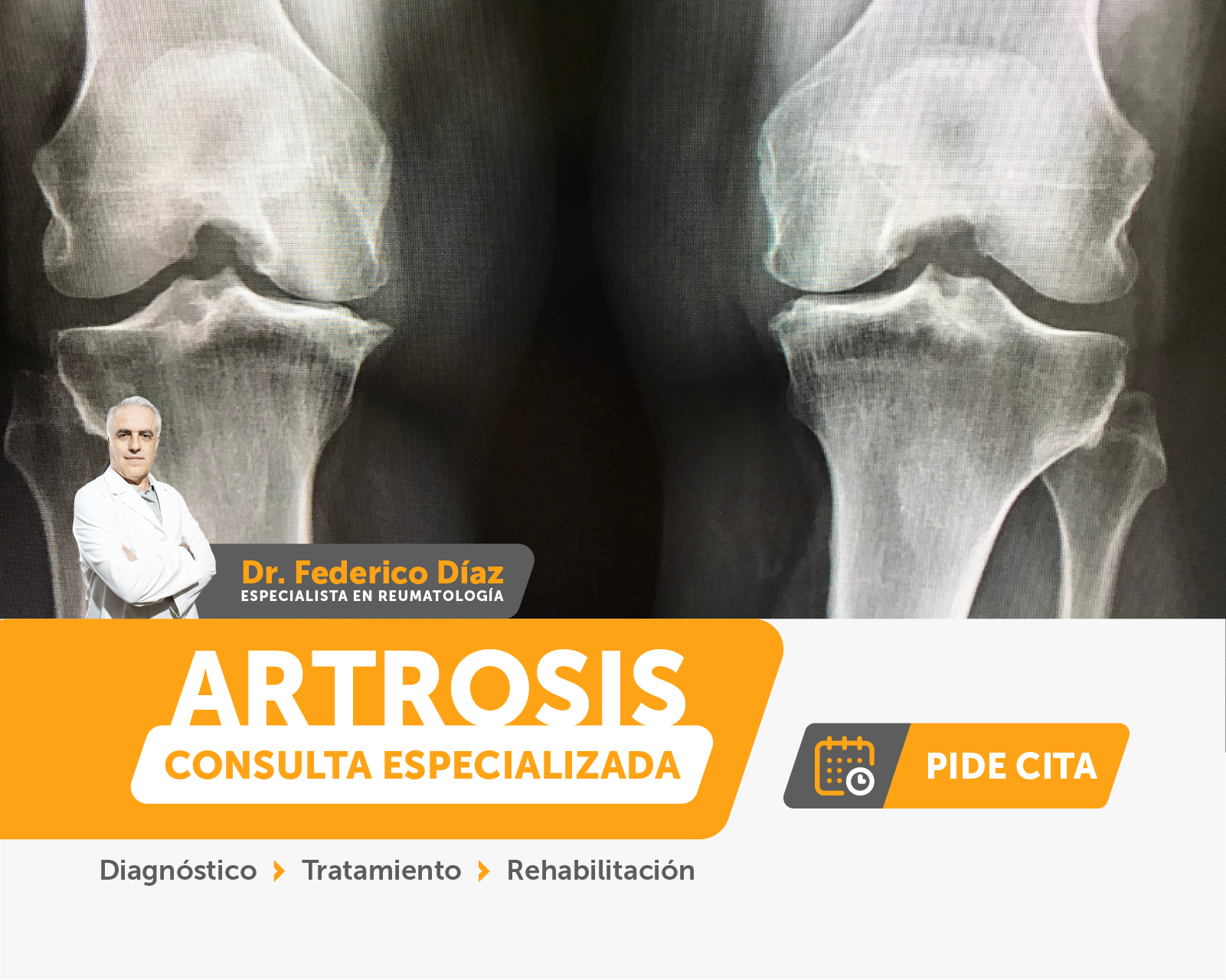 Artrosis - Centro de Salud Pedernera