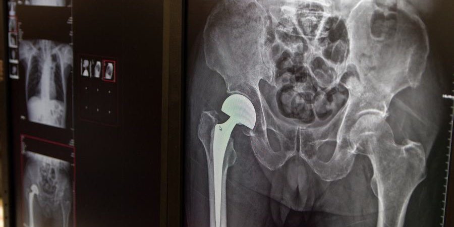 Duración y beneficios de las prótesis articulares