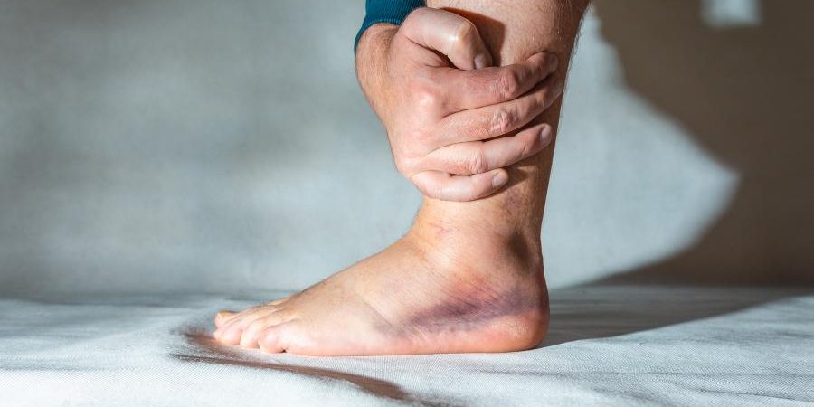 Consecuencias de un esguince mal curado que pasa si un esguince no se cura